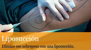 cirugia plastica liposuccion