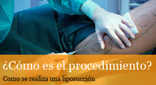 como se hace la liposuccion